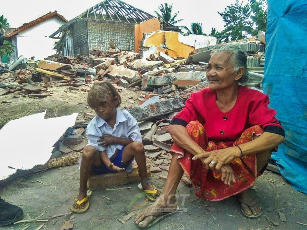 Kisah haru Rika, anak korban gempa Lombok yang mengidap penyakit kusta