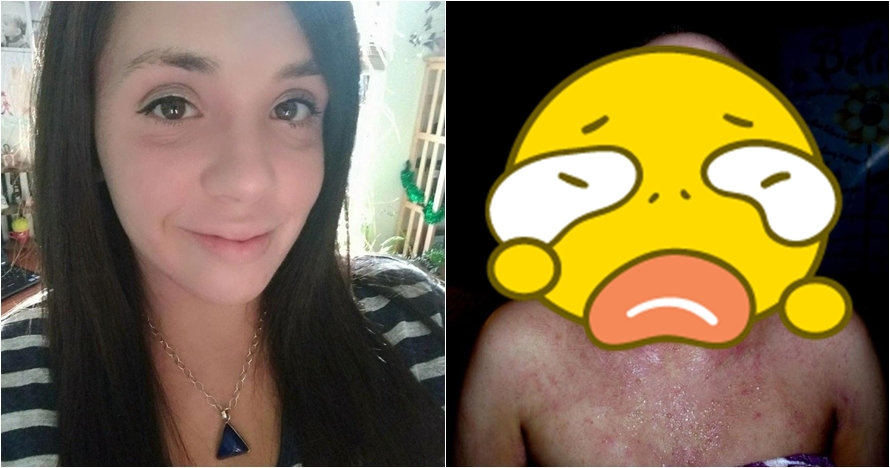 Gara-gara salah pakai krim kulit, nasib wanita ini berakhir tragis