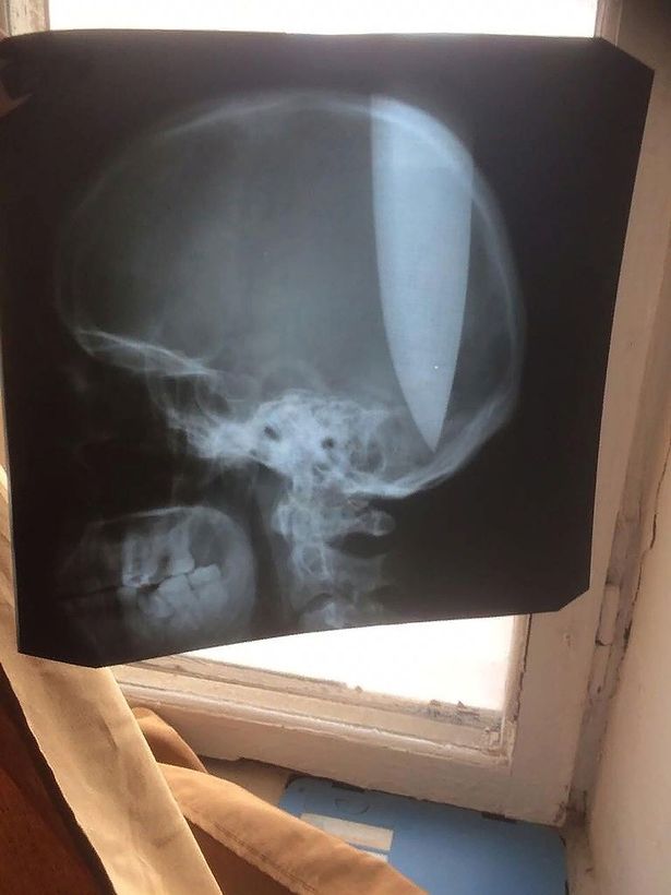 Pria ini tancapkan pisau di kepalanya, alasannya bikin geleng kepala