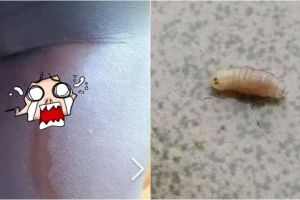 Ngeri, ibu ini temukan empat belatung di dalam tubuh anaknya