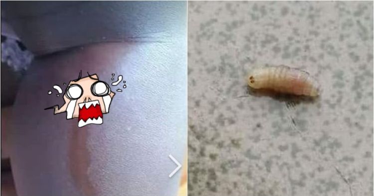 Ngeri, ibu ini temukan empat belatung di dalam tubuh anaknya