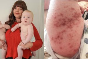 Terinfeksi virus di hotel, kondisi bayi kembar ini bikin merinding