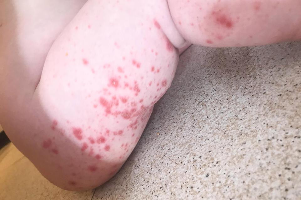 Terinfeksi virus di hotel, kondisi bayi kembar ini bikin merinding