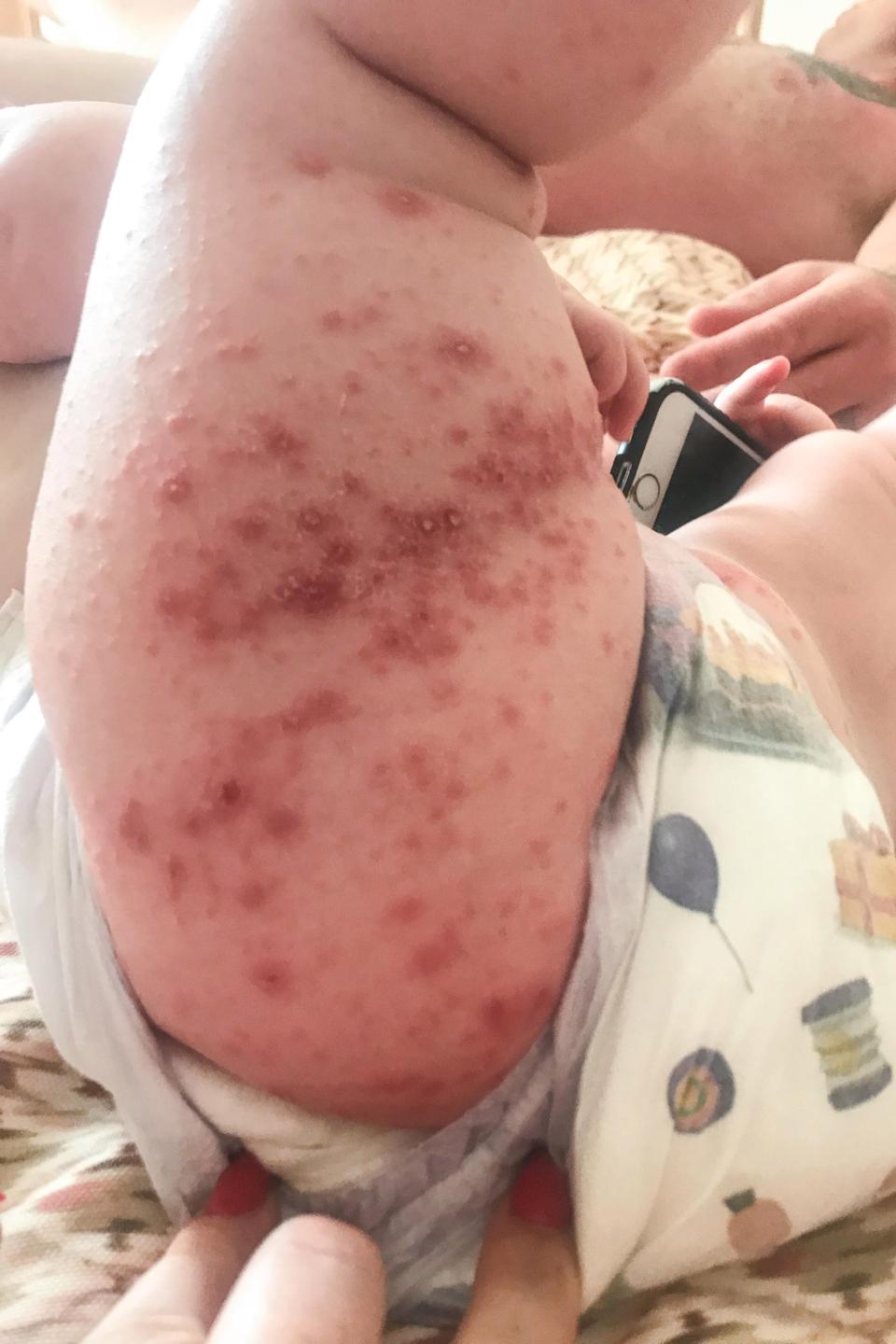 Terinfeksi virus di hotel, kondisi bayi kembar ini bikin merinding