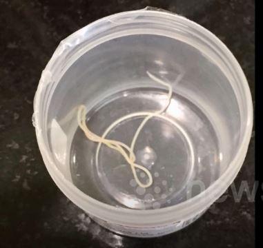 Cacing 15 cm bersarang di mata pria ini, operasinya bikin merinding