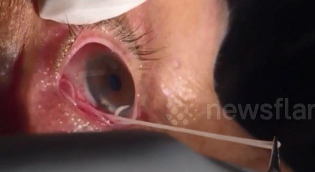 Cacing 15 cm bersarang di mata pria ini, operasinya bikin merinding
