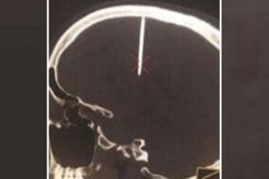 Sakit kepala pria ini tak biasa, penyebabnya bikin bergidik ngeri