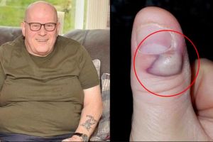 Sering gigit jarinya, pria ini alami nasib tragis