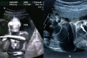 13 Editan foto USG ini nggak biasa, bikin ketawa tepuk jidat