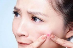 Cara menghilangkan jerawat tanpa merusak keindahan kulit