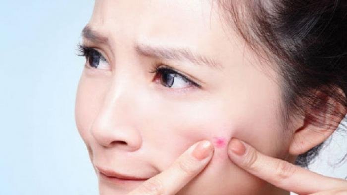 Cara menghilangkan jerawat tanpa merusak keindahan kulit