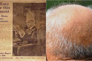 10 Cara atasi kebotakan, ada yang pakai sperma kerbau