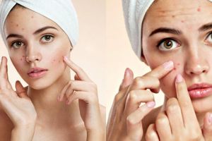 20 Cara menghilangkan jerawat secara alami dan bikin kulit halus