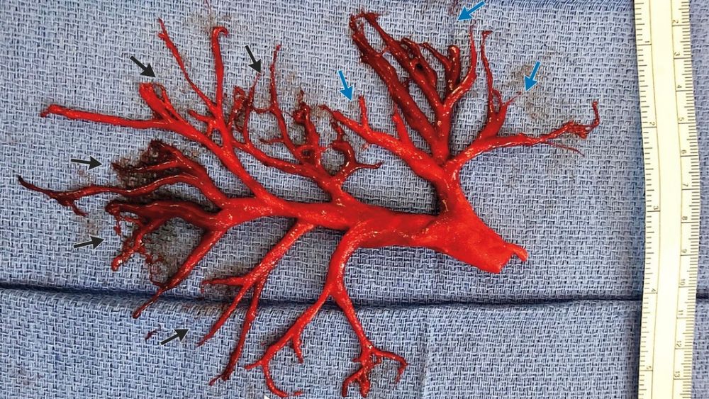 Potret bekuan darah pasien gagal jantung ini seperti akar, ngeri