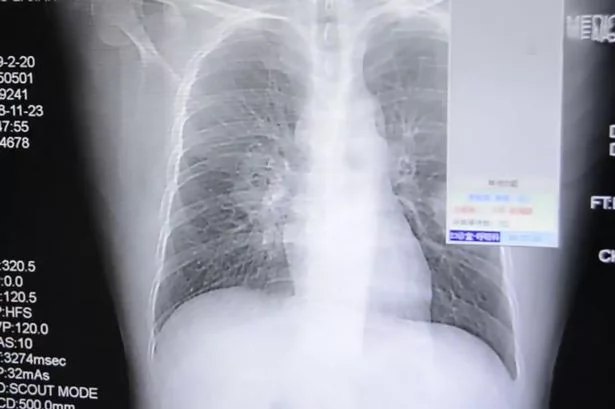 Pria ini dapat infeksi paru-paru akibat cium kaus kaki sendiri