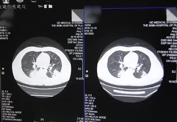 Pria ini dapat infeksi paru-paru akibat cium kaus kaki sendiri