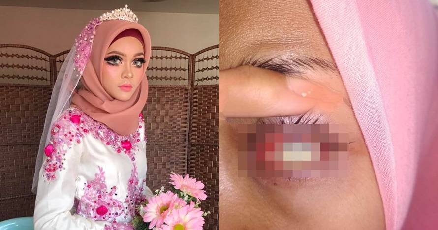 Pakai softlens saat acara pernikahan, nasib pengantin ini tragis