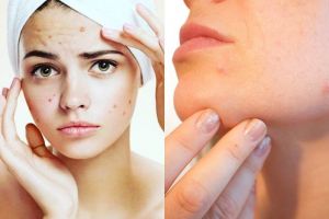 10 Kebiasaan sehari-hari ini bikin jerawat tambah banyak