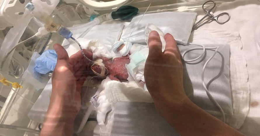 Lahir berbobot 268 gram, ini foto terbaru bayi terkecil di dunia