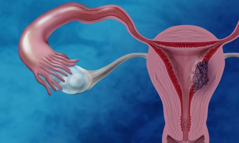 Ini 5 gejala kanker rahim stadium awal, pendarahan tidak wajar