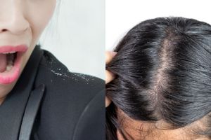 12 Cara menghilangkan ketombe secara alami dan mudah