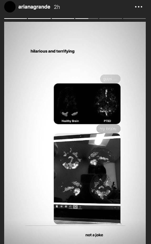 5 Seleb cantik ini menderita penyakit langka, terbaru Ariana Grande