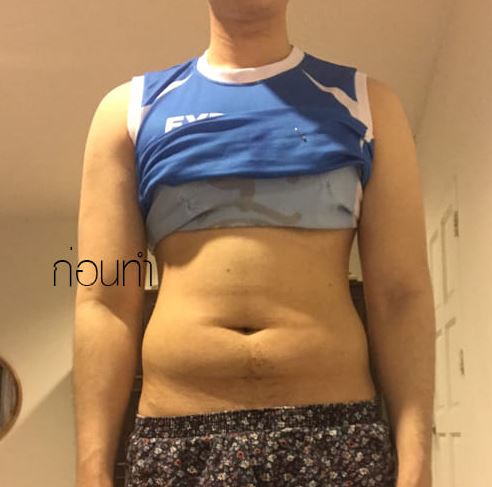 Heboh operasi perut six pack, 8 potret prosesnya bikin ngilu