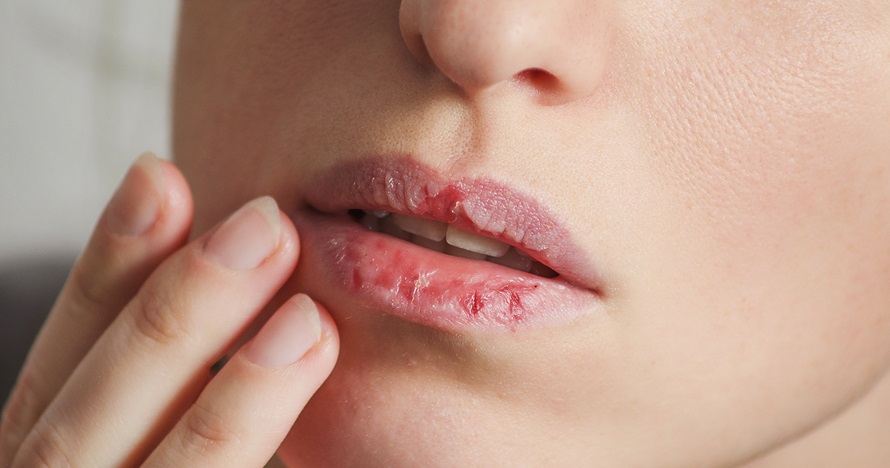 8 Cara mencegah bibir kering selama puasa, mudah & praktis