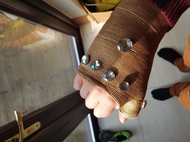 Pria patah tulang bikin perban bak tangan Thanos, ini 10 fotonya