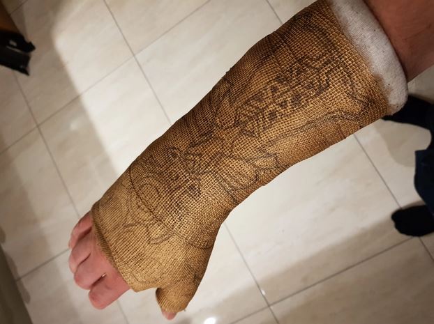 Pria patah tulang bikin perban bak tangan Thanos, ini 10 fotonya