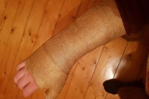 Pria patah tulang bikin perban bak tangan Thanos, ini 10 fotonya