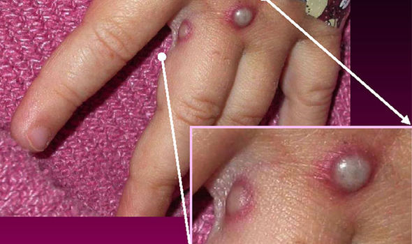 5 Fakta cacar monyet, penyakit langka yang ditemukan di Singapura