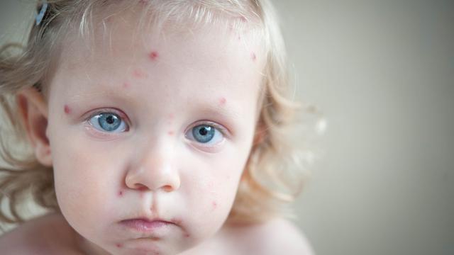 4 Beda penyakit cacar air dan cacar monyet, waspada ya