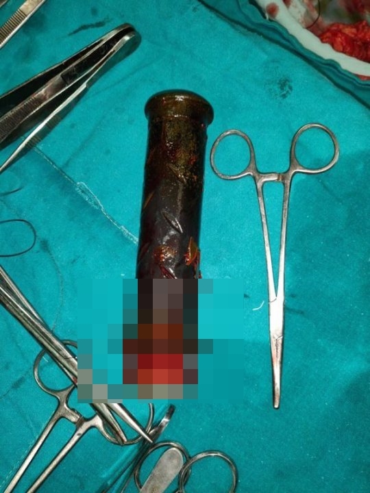 Akibat KDRT, stang motor tertinggal dua tahun di rahim wanita ini