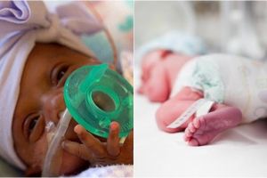 Bayi termungil lahir di dunia, beratnya setara dengan sebuah apel