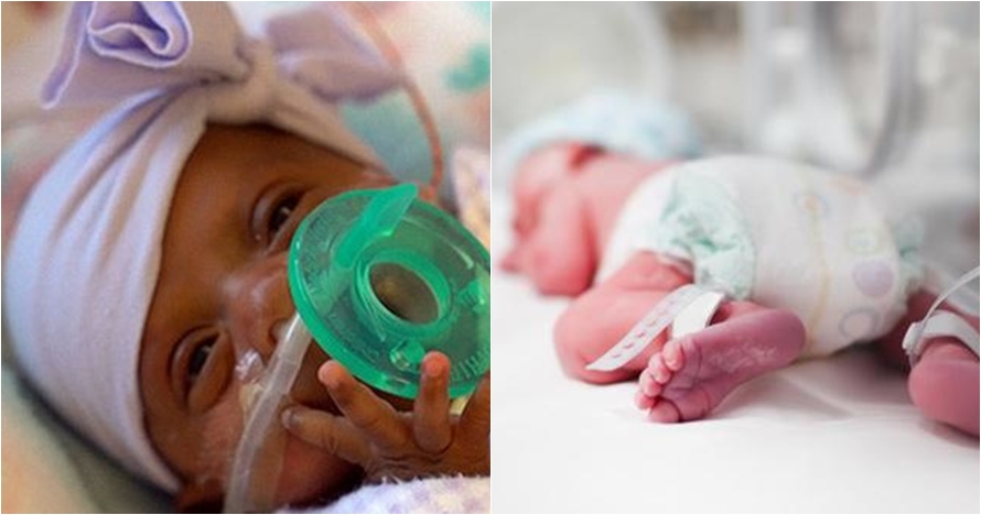 Bayi termungil lahir di dunia, beratnya setara dengan sebuah apel