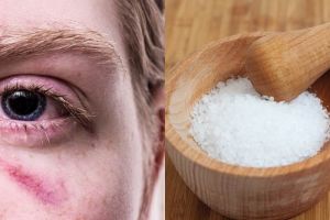 10 Cara cepat hilangkan mata bengkak karena menangis