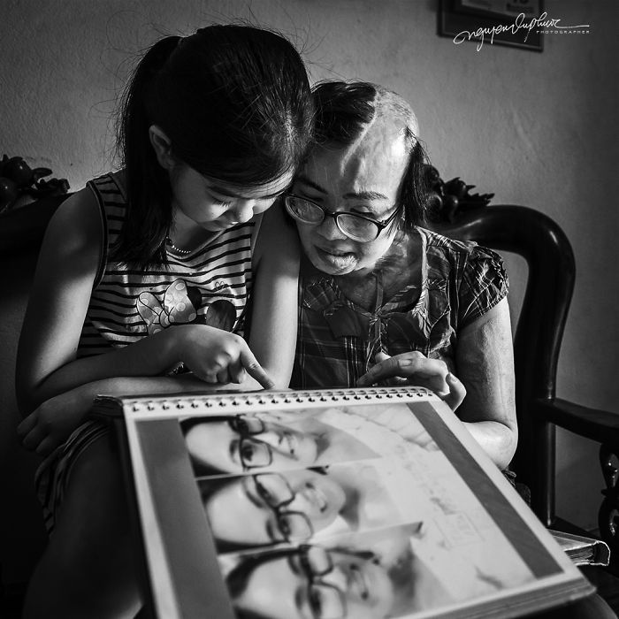 Kisah wanita yang disiram air keras oleh mantan suami, bikin haru