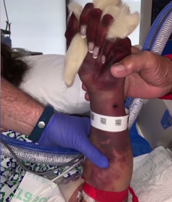 Bermula kena liur anjing, wanita ini kehilangan kaki & tangannya