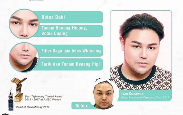 Perubahan 4 seleb pria sebelum & sesudah botoks, bikin pangling