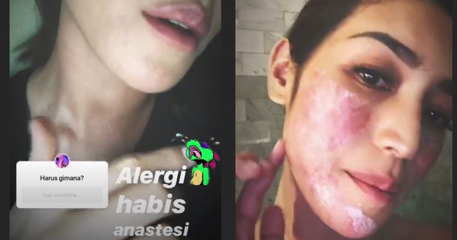 Muncul bercak merah di wajah, Jessica Iskandar ungkap penyebabnya