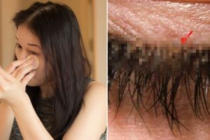 Wanita ini hampir terkena penyakit serius sebab malas bersihkan makeup