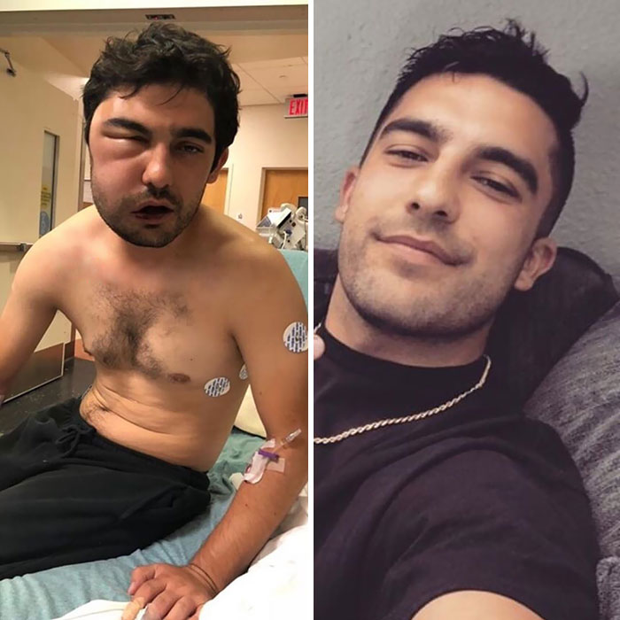 11 Potret perubahan wajah sebelum & sesudah sembuh dari narkoba