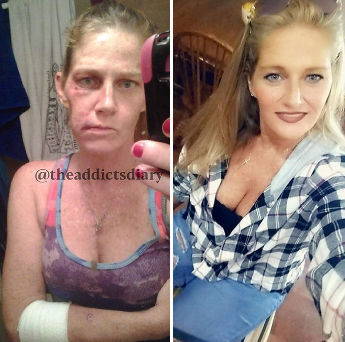 11 Potret perubahan wajah sebelum & sesudah sembuh dari narkoba