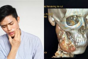 Sakit gigi setahun tak sembuh, remaja 15 tahun ini derita tumor