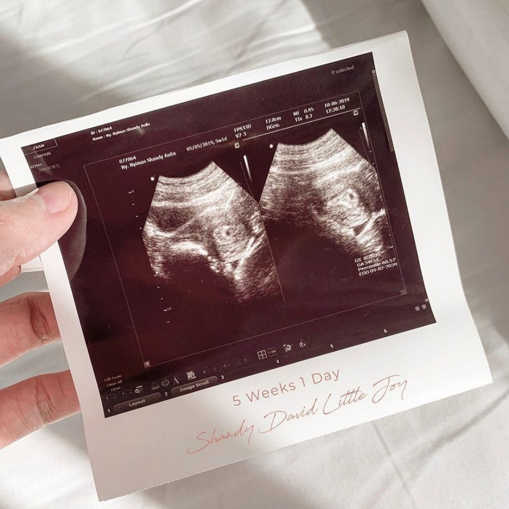 Sedang hamil, ini 10 foto USG yang kerap dipamerkan Shandy Aulia