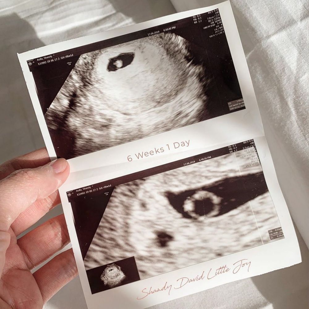 Sedang hamil, ini 10 foto USG yang kerap dipamerkan Shandy Aulia