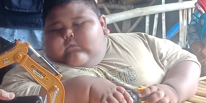 Obesitas telat ditangani, bocah di Karawang meninggal dunia