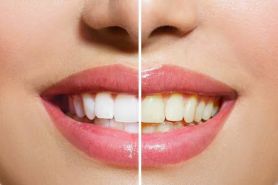 13 Cara alami memutihkan gigi, ampuh dan tanpa efek samping