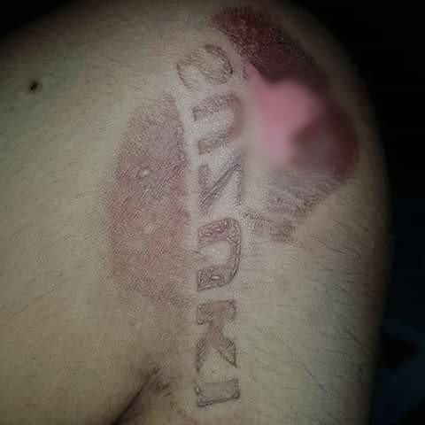 8 Bentuk bekas luka di kulit ini bikin melongo